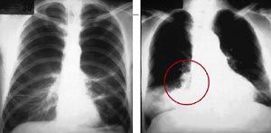 sintomas de cancer sintomas de cancer