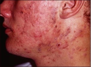 Como evitar acne por esteroides