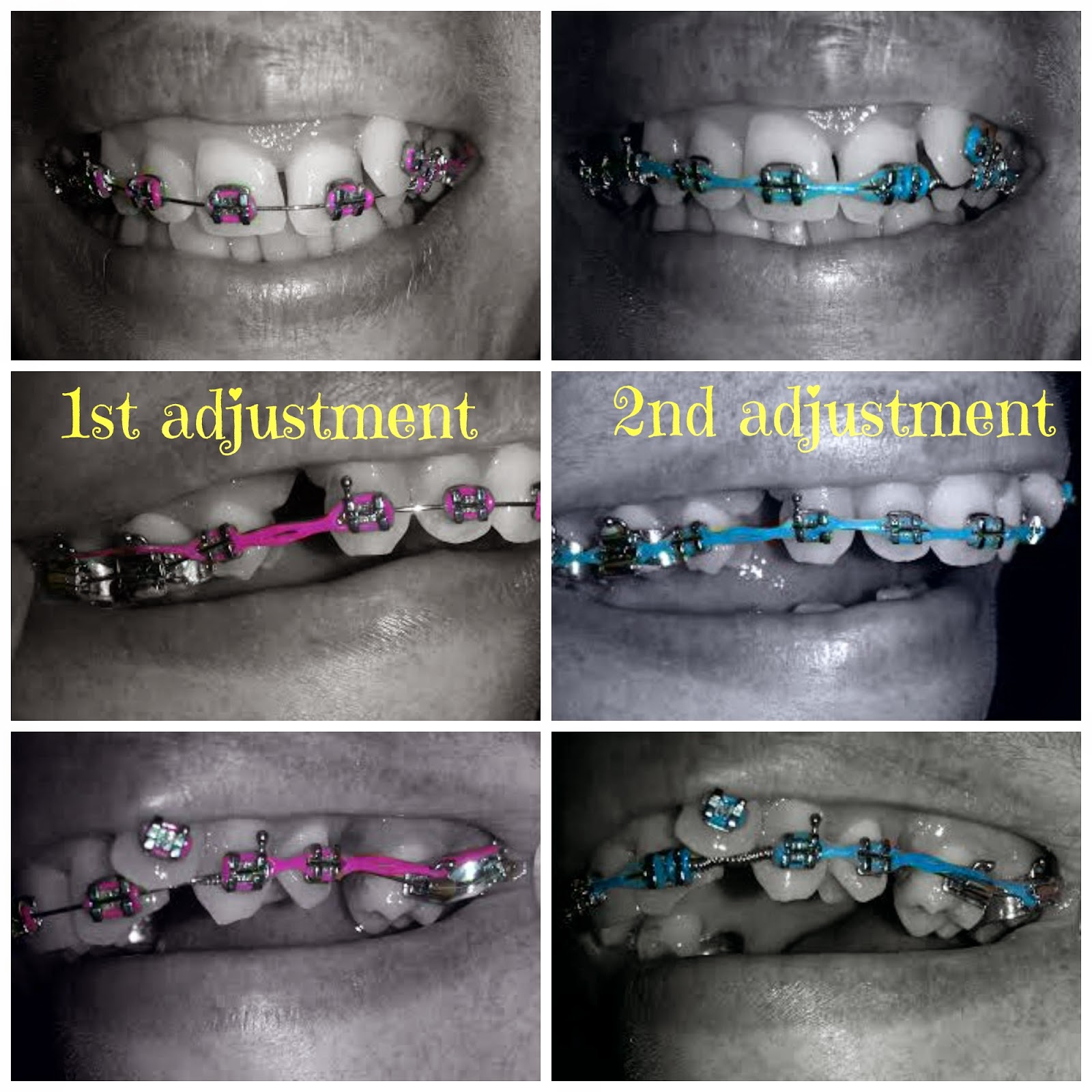 Adult Braces My Journey 2nd Braces Adjustment