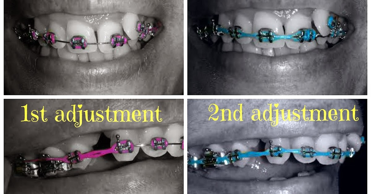 Adult Braces My Journey 2nd Braces Adjustment