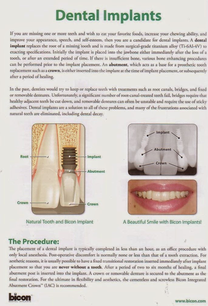 Dental Implants