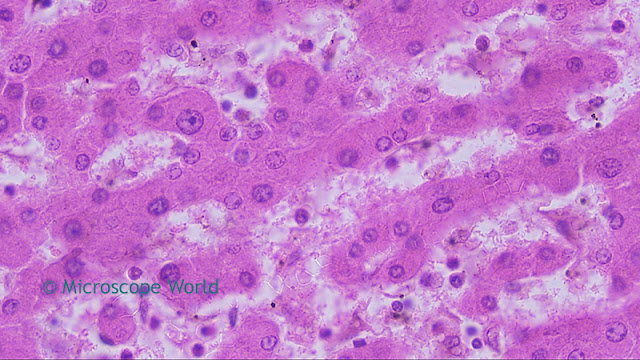 Microscope World image of cirrhosis of the liver at 400x.