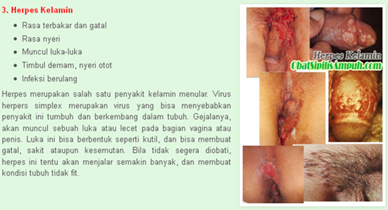 penyakit herpes kelamin herpes, herpes kelamin, penyakit herpes kelamin, gambar penyakit herpes kelamin, gejala penyakit herpes kelamin