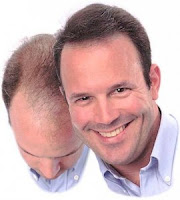 causas de la caida del cabello causas de la caida del cabello