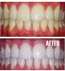 teeth whitening teeth whitening and