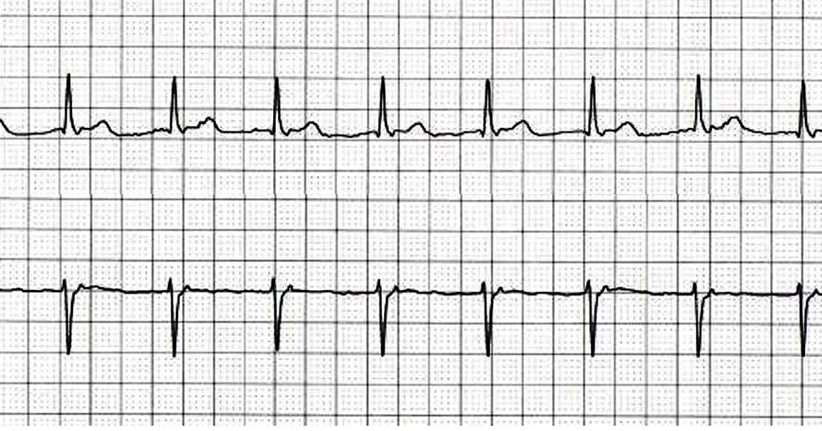 ECG Rhythms Isorhythmic AV dissociation