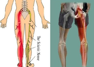 Differential Diagnosis : Degeneration vs Prolapse vs Herniation vs