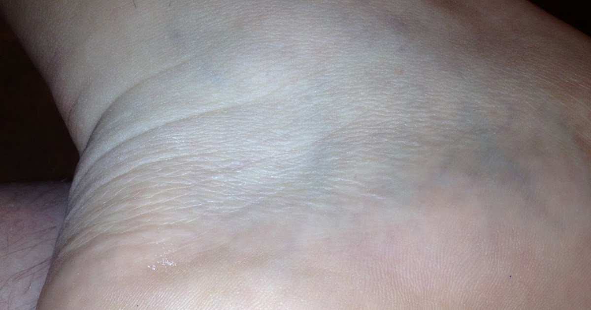 My Running Doc Heel Blister To Pop or Not To Pop?