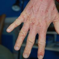 Topical steroid withdrawal period