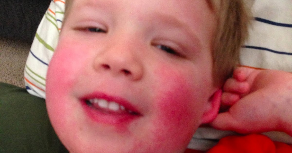 just us. The one with hives, and fever, and strep throat, and fifth disease