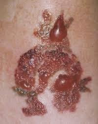 Tattoo Aftercare - Ignore It, and Your Boom Ability End Up a Mess