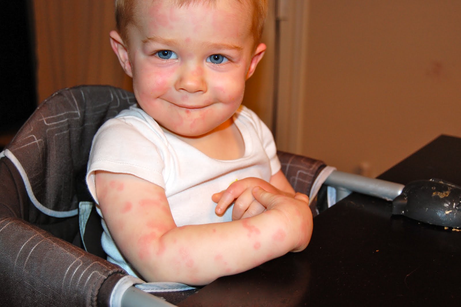 The Pattersons Deacon's weird disease.