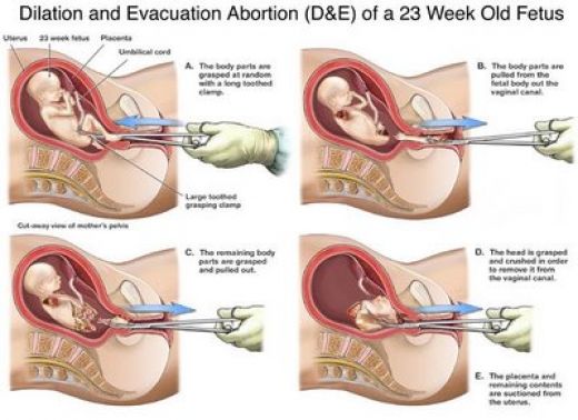 abortion 3 months