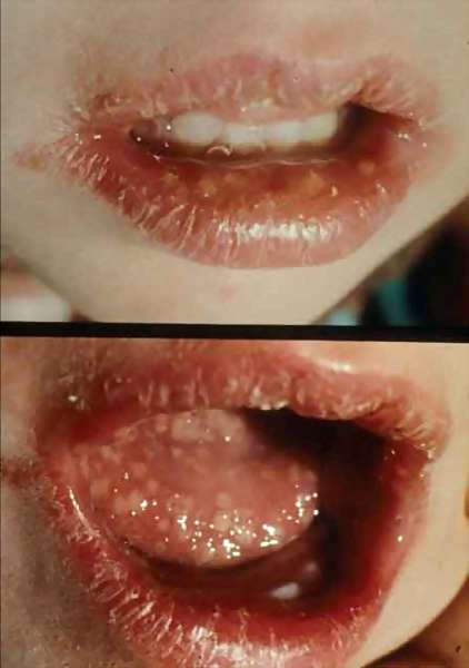 image of pictures of penis with herpes