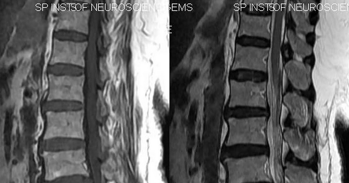 Neuroradiology Cases Intradiscal Vacuum Phenomenon