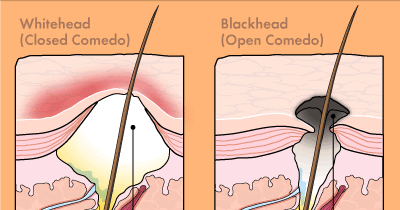 whiteheads treatment how do whiteheads form