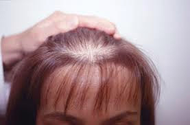 Hajhullás alopecia