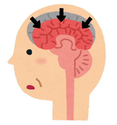 認知症の脳のイラスト（アルツハイマー型）
