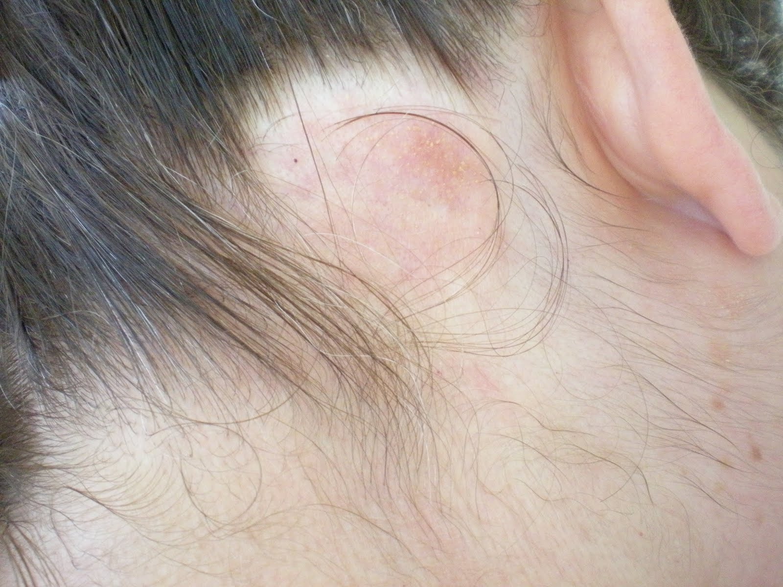 lump on s back the gallery for gt lump back of neck lymphoma lump on s back the gallery for gt lump back of neck lymphoma