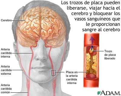 Causas Y Consecuencias De Un Accidente Cerebrovascular