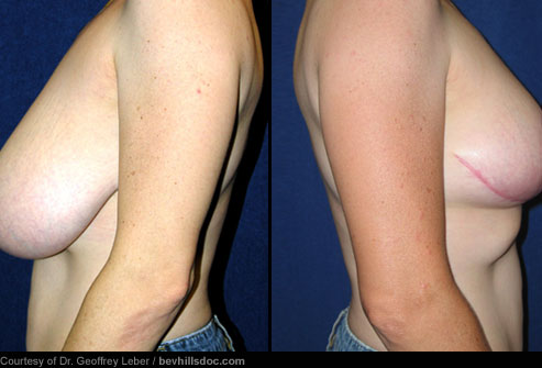breast reduction recovery. Breast Reduction: Before amp;