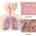 Nursing Assessment for COPD