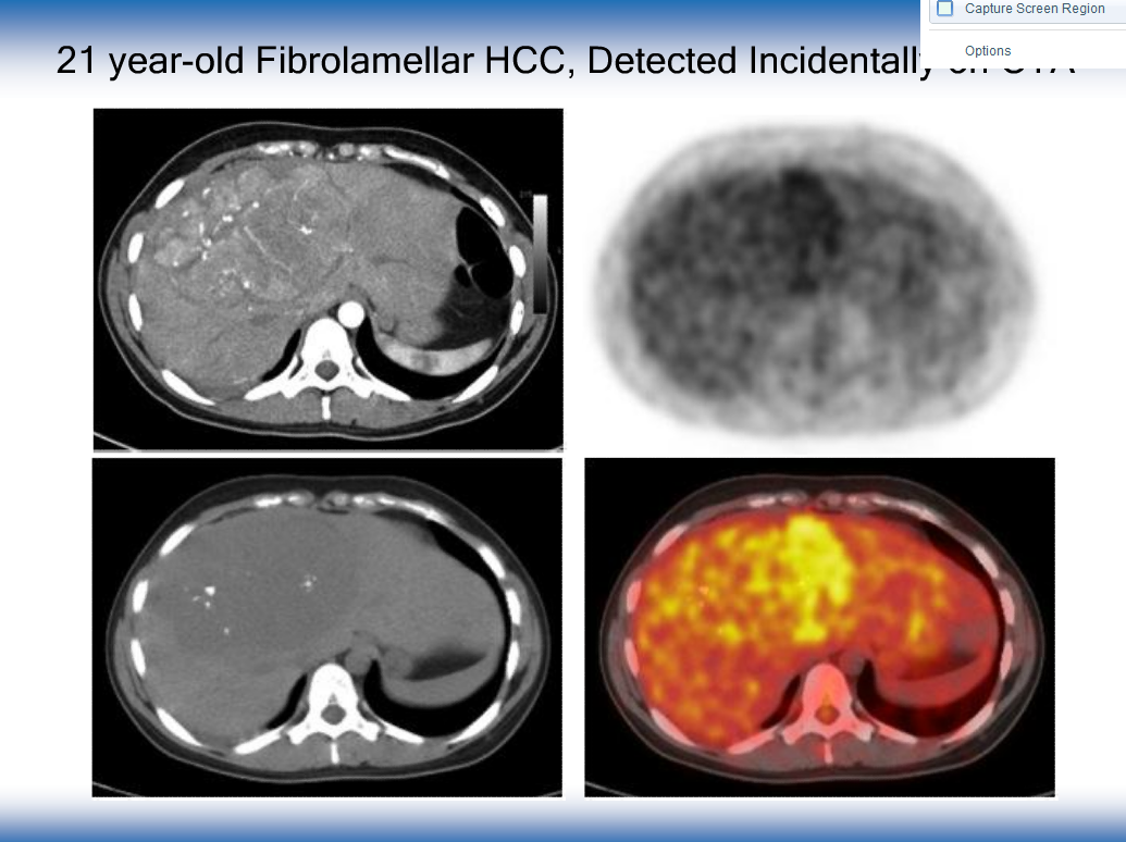 pet ct in pediatric oncology