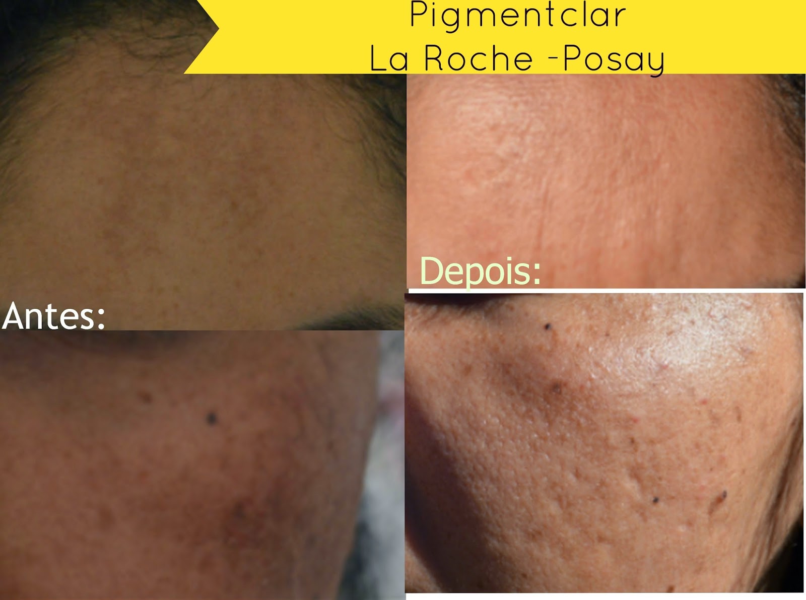 Resenha: Pigmentclar, da La Roche Posay | Woman Chic