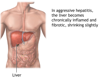 Ayurvedic Remedy and Symptom for Chronic hepatitis