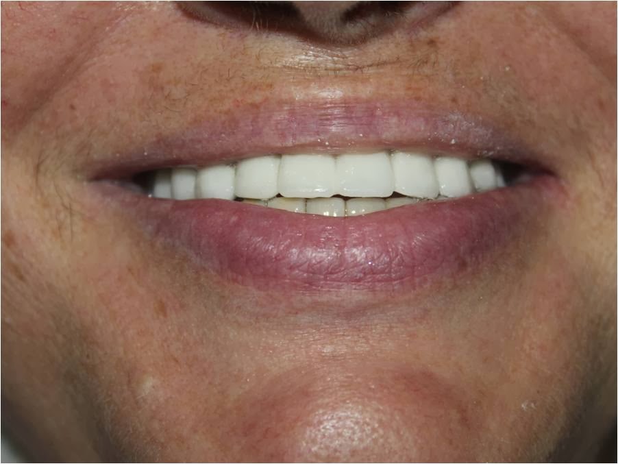 FULL UPPER ARCH DENTAL IMPLANTS COST IN INDIA