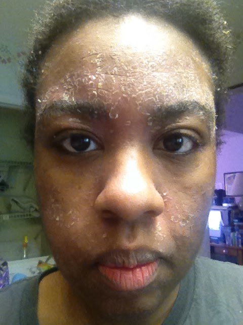 Laurel S Blog Warning The Famous Proactiv Skin Cleanser Ruined My Skin