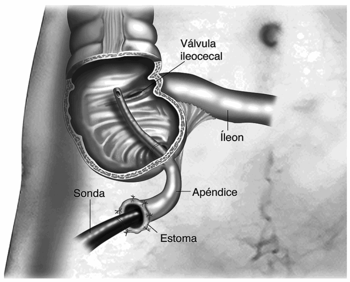 I want to learn About Spina Bifida What is the MACE