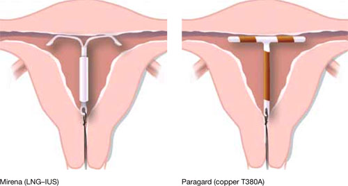 womens health contraception continued mirena size