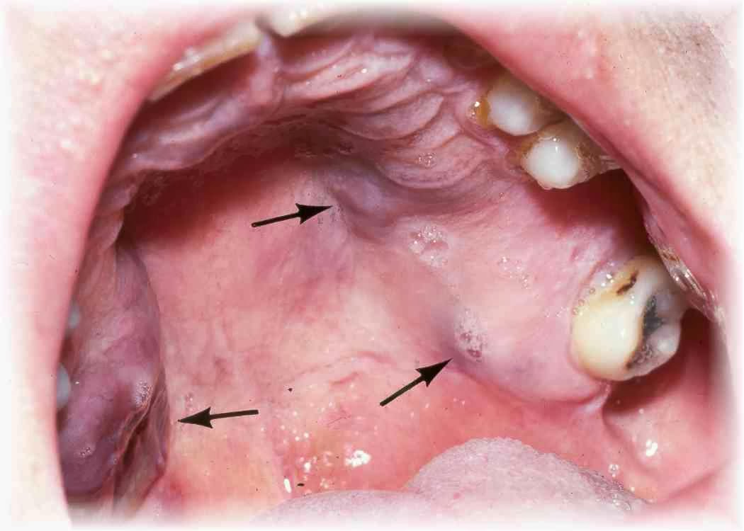 Anaerobic Bacteria In Mouth 51