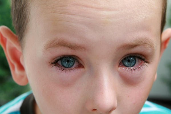 Pink Eye Pink Eye
