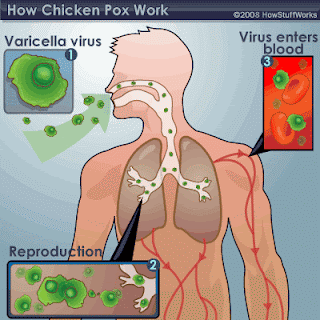 chicken pox