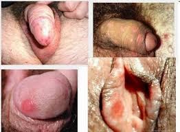 sipilis obat sipilis