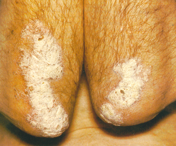 El corazoncillo al tratamiento de la psoriasis