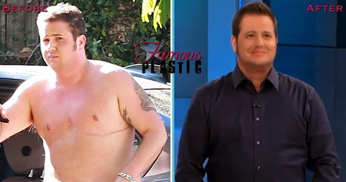 chaz surgery