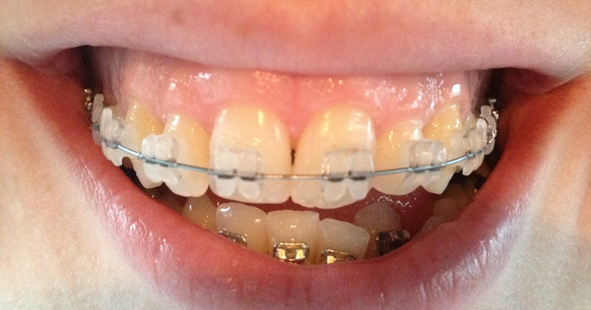 Braces Chick Lets try smoke!