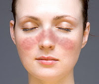symptoms of lupus disease