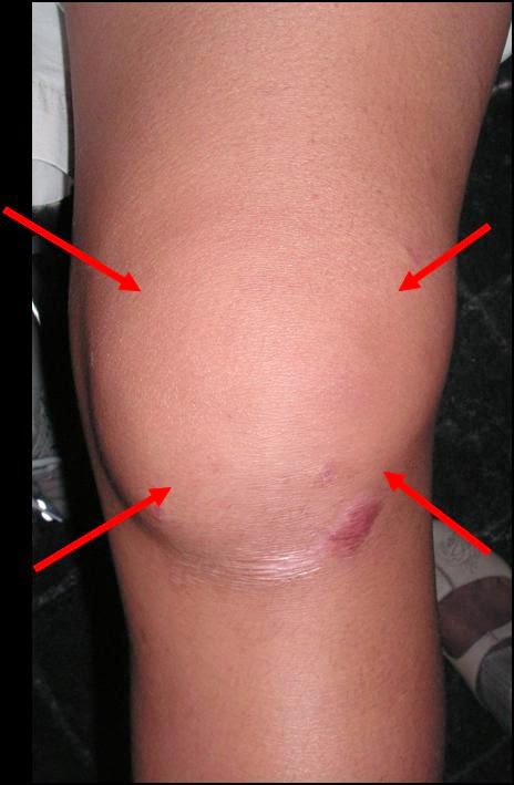 Tips Curing Disease How To Help Fluid On The Knee