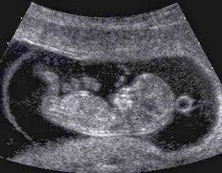 hamilelikte ultrason