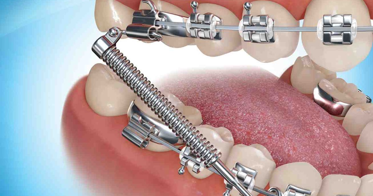 Surrideo Orthodontics Damon Braces Invisalign Incognito Forsus