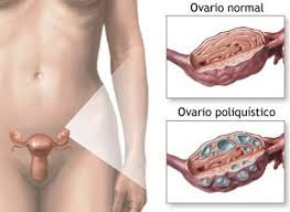 8 Tratamientos Naturales Para Combatir Quistes De Ovario