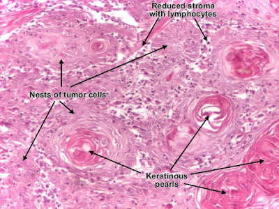 Histology and explanation of Squamous cell carcinoma (skin)