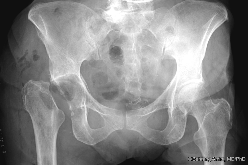 Roentgen Ray Reader Girdlestone Resection Arthroplasty