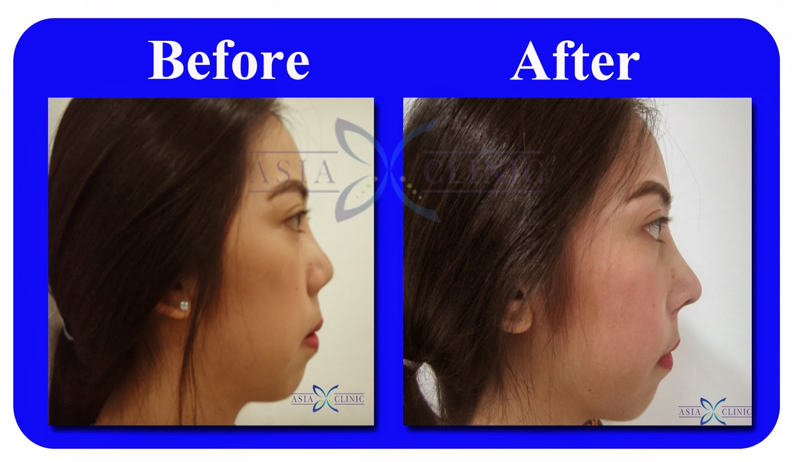 Rhinoplasty Surgery Thailand Nose Augmentation Before And After Photos