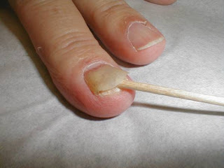 onycholysis - nail coming off