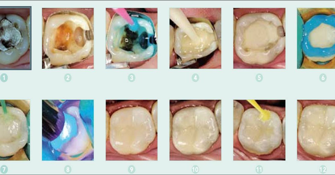 Dental materials Glass Ionomer Composite "sandwich" technique when is the time to etch?